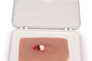 Wundmoulage offener Knochenbruch