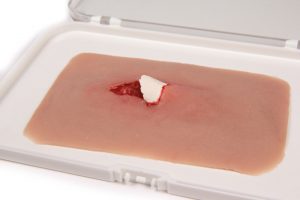 Wundmoulage offener Knochenbruch