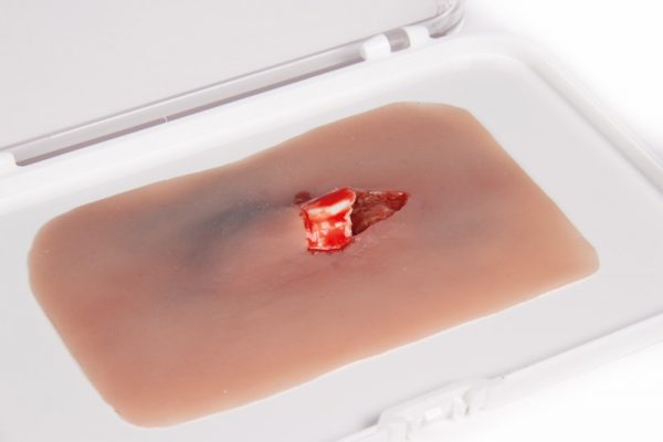 NW004_4 Wundmoulage offener Knochenbruch