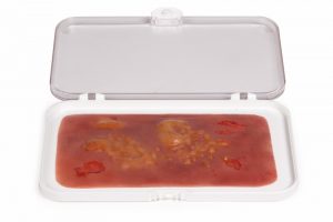 Wundmoulage Brandwunde 2. Grades