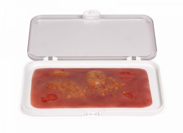 NW007 Wundmoulage Brandwunde 2. Grades