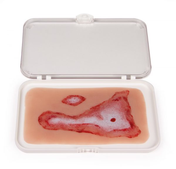 NW011_1 Wundmoulage Verbrühung