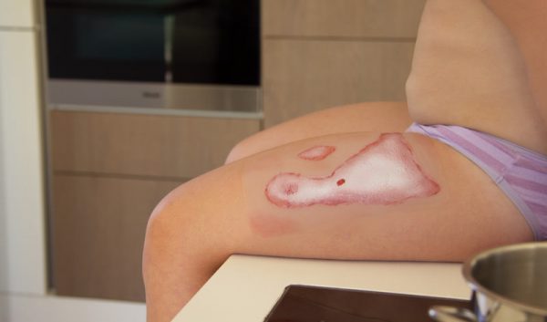 NW011_Action1 Wundmoulage Verbrühung