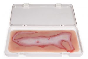 Wundmoulage Verbrühung