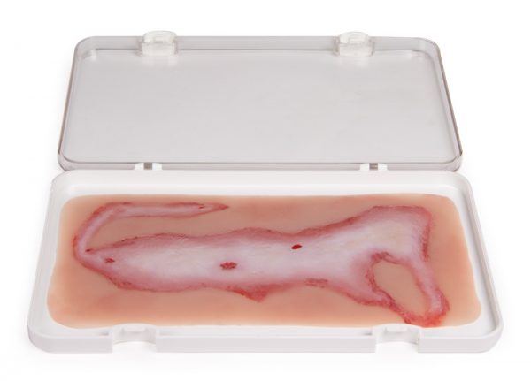 NW108 Wundmoulage Verbrühung