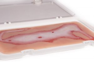 Wundmoulage Verbrühung