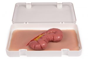 Wundmoulage Dickdarmaustritt