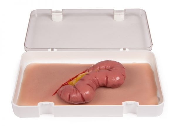 NW109 Wundmoulage Dickdarmaustritt