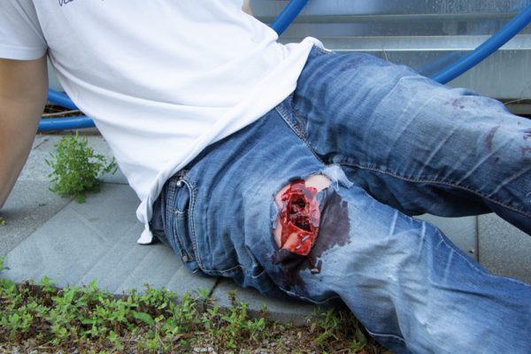 NW110_Action2 Wundmoulage wound packing