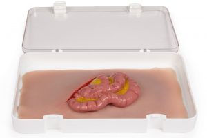 Wundmoulage Dünndarmaustritt