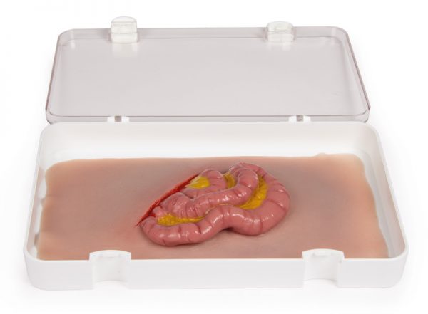 NW111 Wundmoulage Dünndarmaustritt