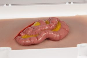 Wundmoulage Dünndarmaustritt