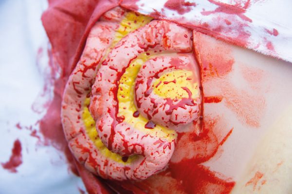 NW111_Action2 Wundmoulage Dünndarmaustritt