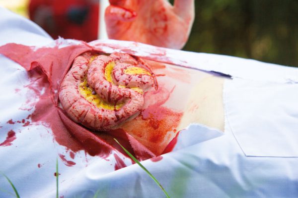 NW111_Action3 Wundmoulage Dünndarmaustritt