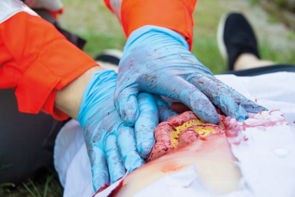 NW111_Action4 Wundmoulage Dünndarmaustritt